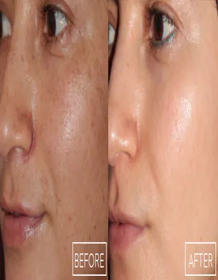 BBL Hero Laser Treatment